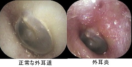 喉 の 奥 白い 粒