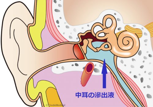 舐め 中耳炎 耳 彼女が耳舐めてくるんだけど耳の穴に舌入れるから唾液が入ってやばい