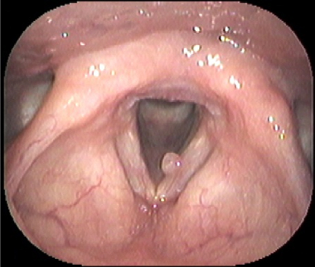 throat_polyp