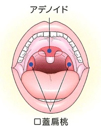 アデノイド