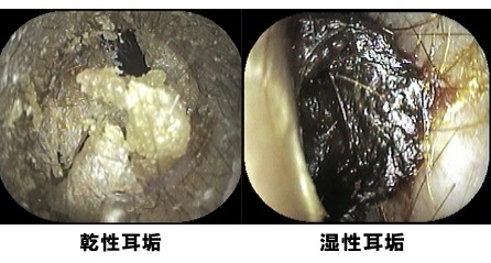 耳垢 かさぶた