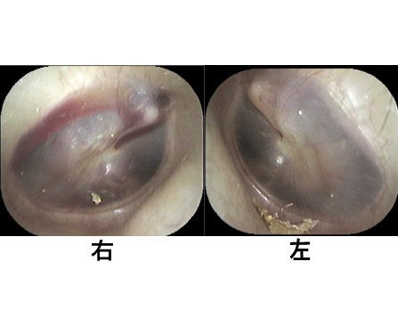 航空性中耳炎