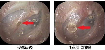 穿孔＆閉鎖