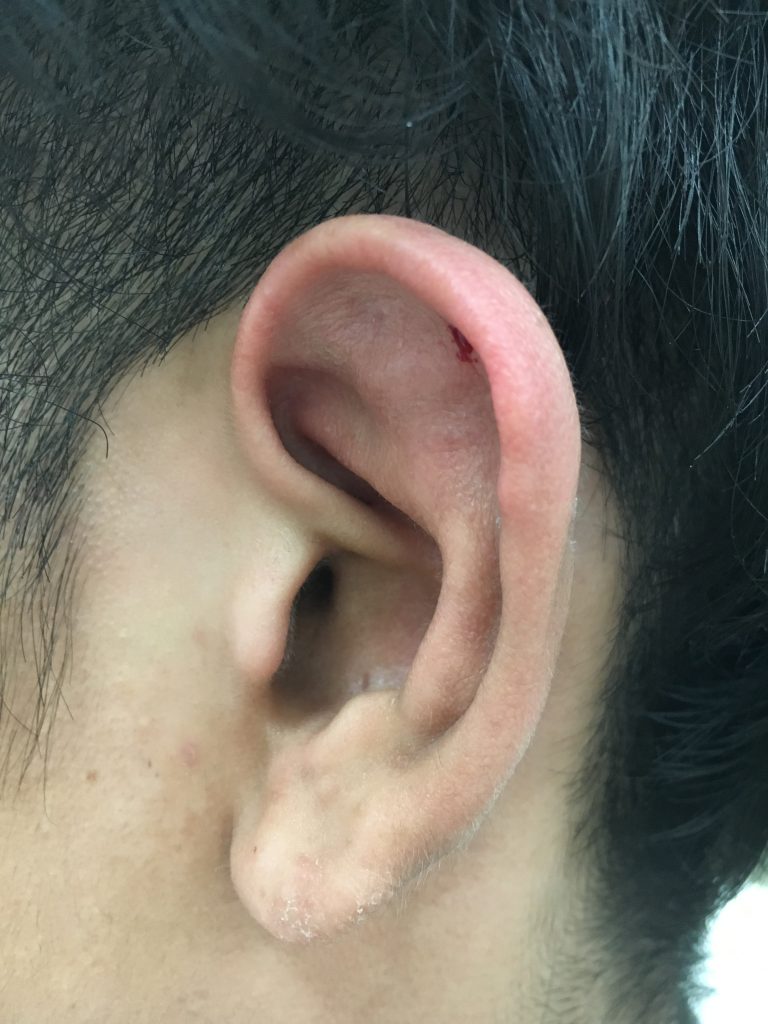 耳 の 前 腫れ