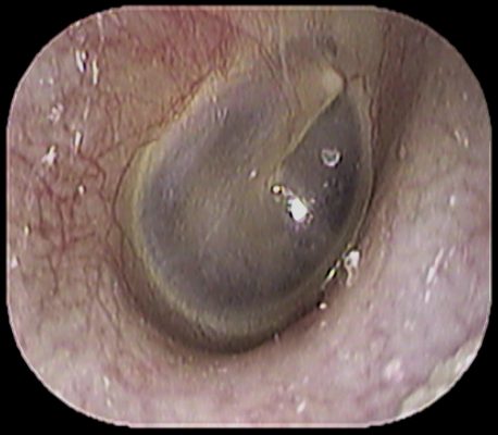 外耳道真菌症 いのうえ耳鼻咽喉科 外耳道真菌症 いのうえ耳鼻咽喉科