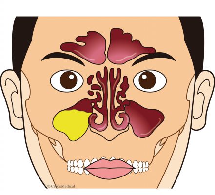 ロゴ入り図解副鼻腔の構造別パターン