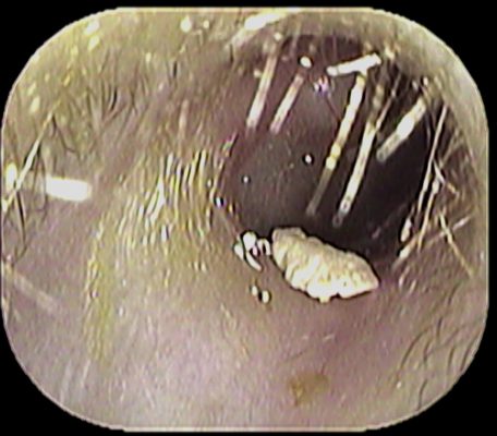 耳に白いものが いのうえ耳鼻咽喉科 耳に白いものが いのうえ耳鼻咽喉科