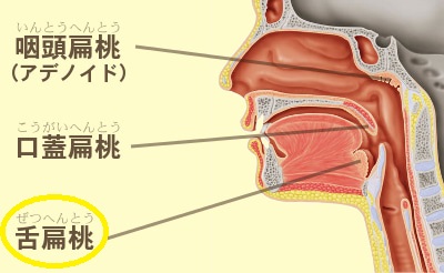 舌扁桃