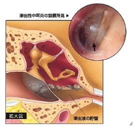 を 耳 と 唾 が バリバリ 飲む 耳の奥で変な音！唾を飲むと「バリバリ」寝る時に「ザーザー」…耳鼻科に行った診断結果は？