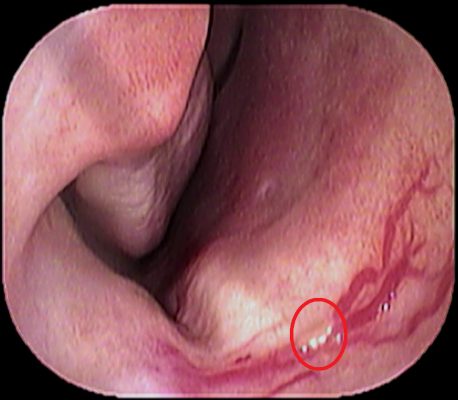 子供の鼻出血 いのうえ耳鼻咽喉科 子供の鼻出血 いのうえ耳鼻咽喉科