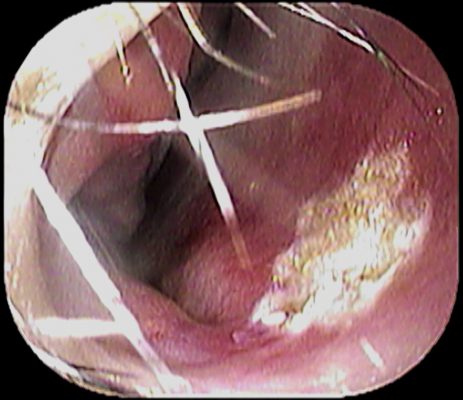 子供の鼻出血 いのうえ耳鼻咽喉科 子供の鼻出血 いのうえ耳鼻咽喉科