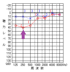 自声強聴1