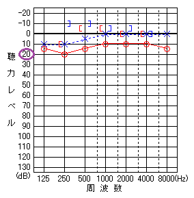 自声強聴2