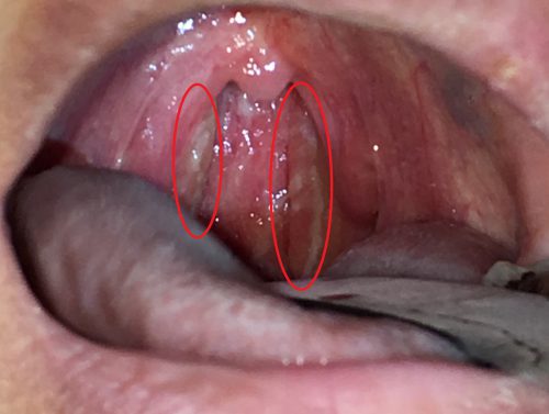 40 の熱 いのうえ耳鼻咽喉科 40 の熱 いのうえ耳鼻咽喉科