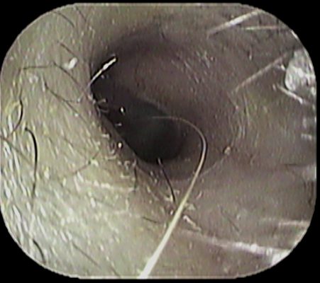 耳に の毛が いのうえ耳鼻咽喉科 耳に の毛が いのうえ耳鼻咽喉科