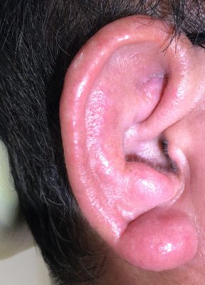 耳たぶ 腫れる