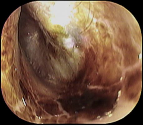 赤ちゃんの耳 いのうえ耳鼻咽喉科