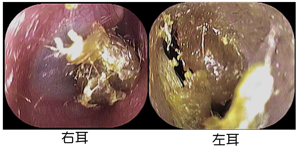 耳垢は大変 いのうえ耳鼻咽喉科