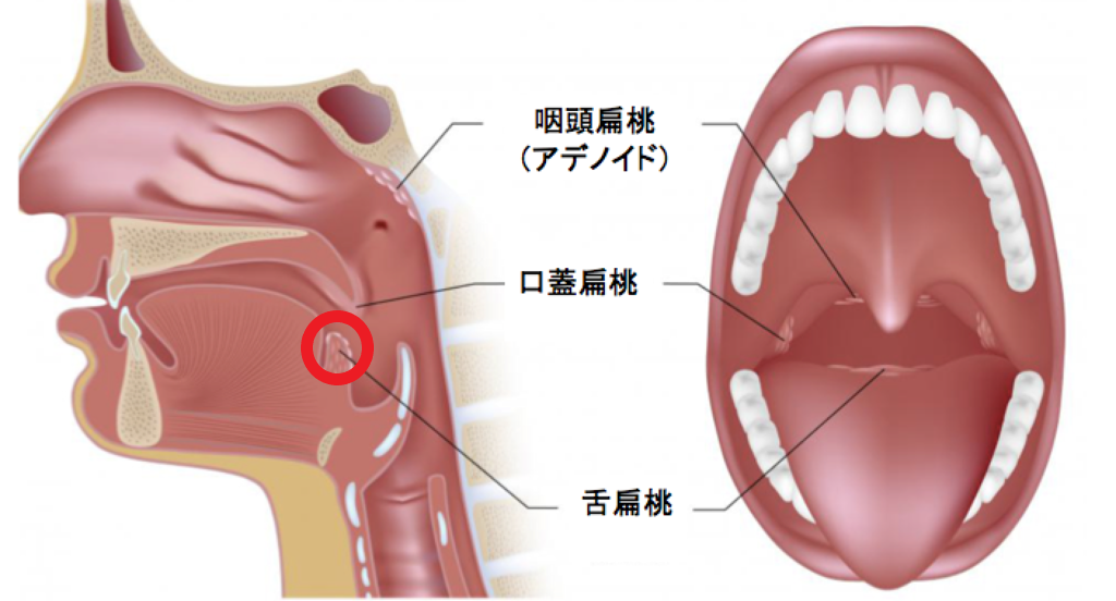 のどのイボ いのうえ耳鼻咽喉科 のどのイボ いのうえ耳鼻咽喉科