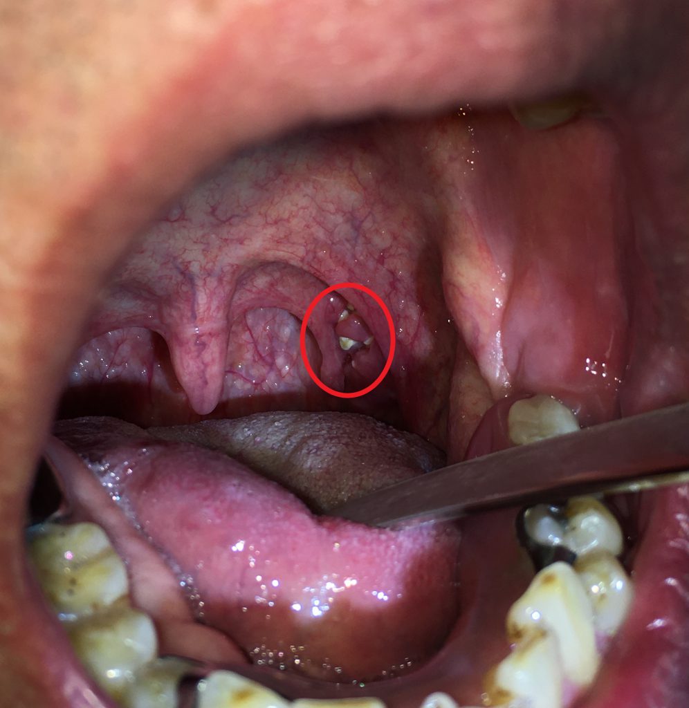 喉 の 奥 白い 膜