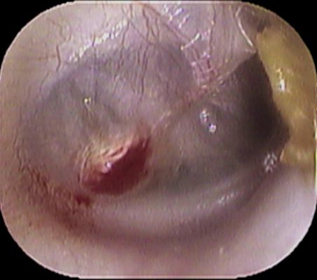 子供の耳掃除に注意 いのうえ耳鼻咽喉科 子供の耳掃除に注意 いのうえ耳鼻咽喉科