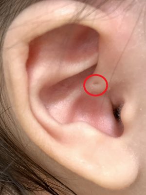 先天性耳瘻孔 せんてんせい じろうこう いのうえ耳鼻咽喉科