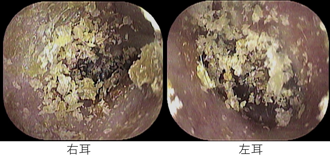 耳掃除のしすぎに注意 いのうえ耳鼻咽喉科