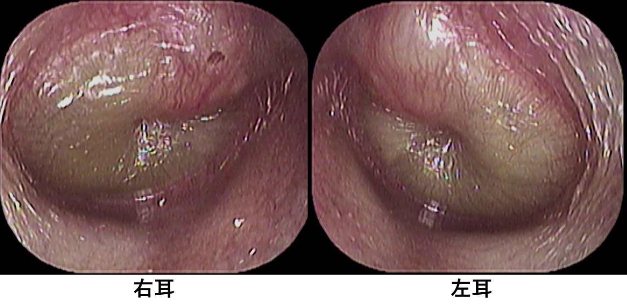 カテゴリ 診療について のブログ記事 いのうえ耳鼻咽喉科