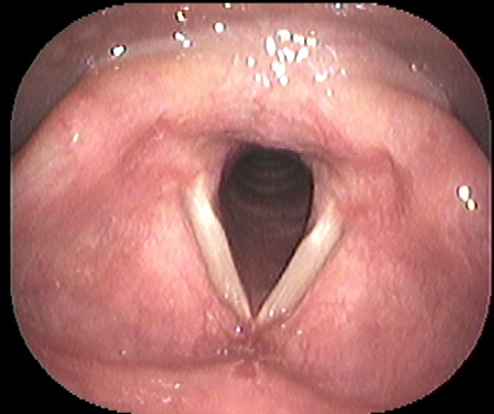 カテゴリ 診療について のブログ記事 いのうえ耳鼻咽喉科
