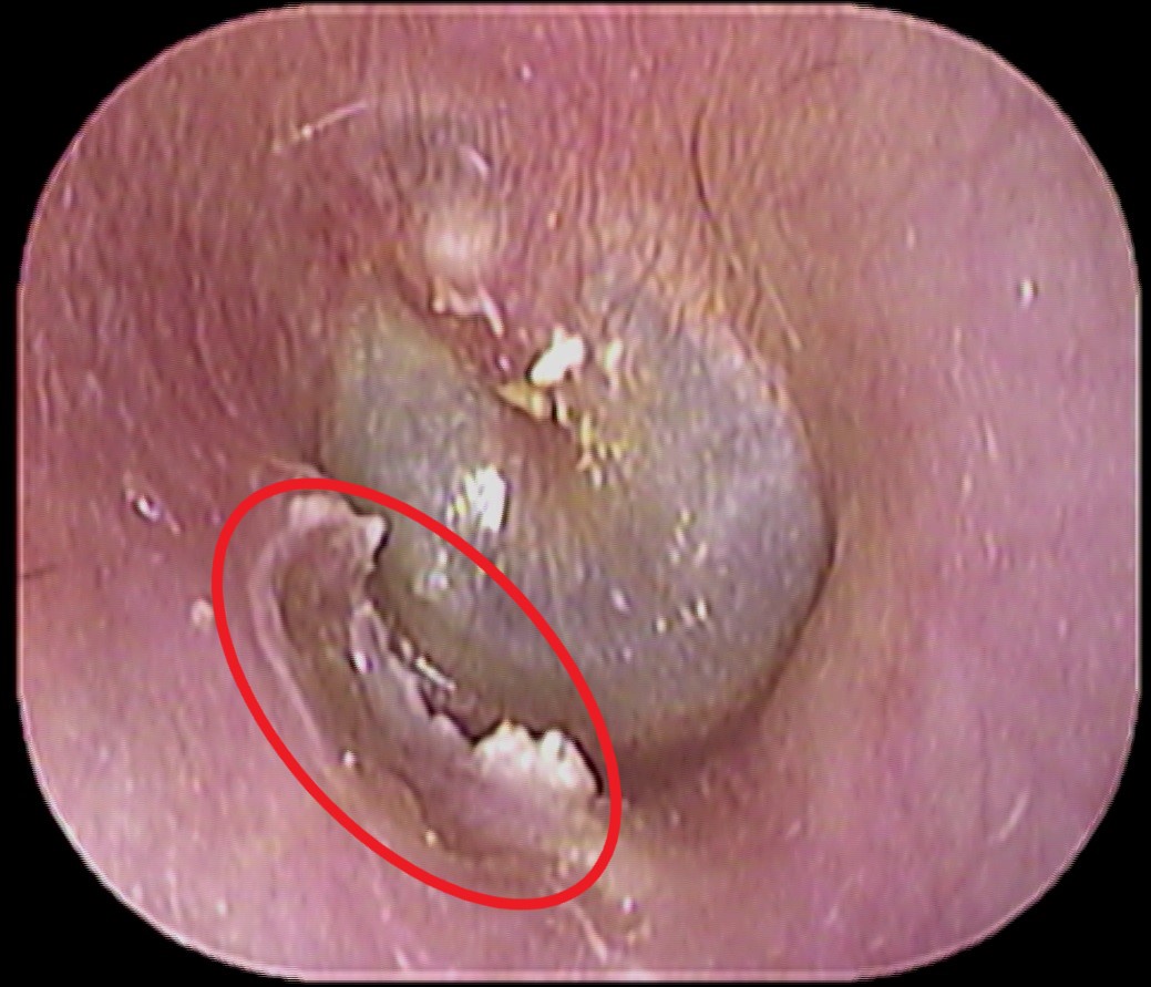 カテゴリ 診療について のブログ記事 いのうえ耳鼻咽喉科