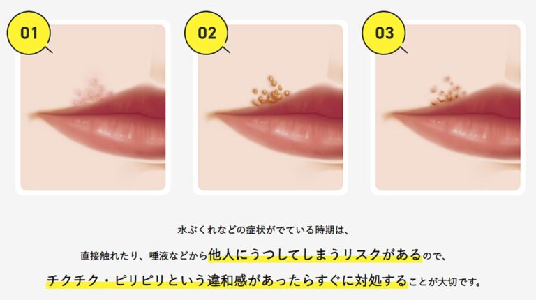 herpes01-768x430