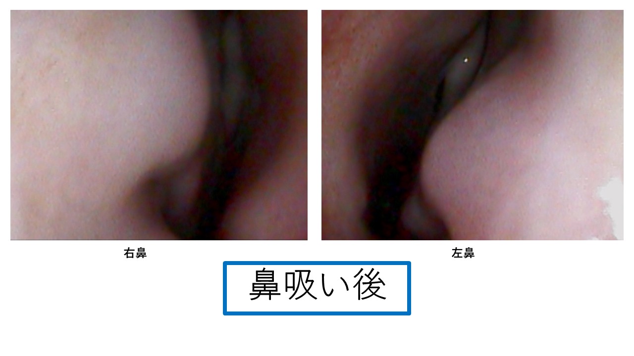 鼻吸い前