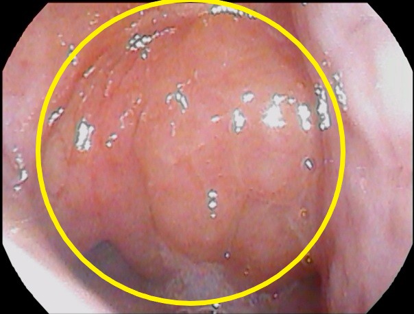 アデノイド (2)