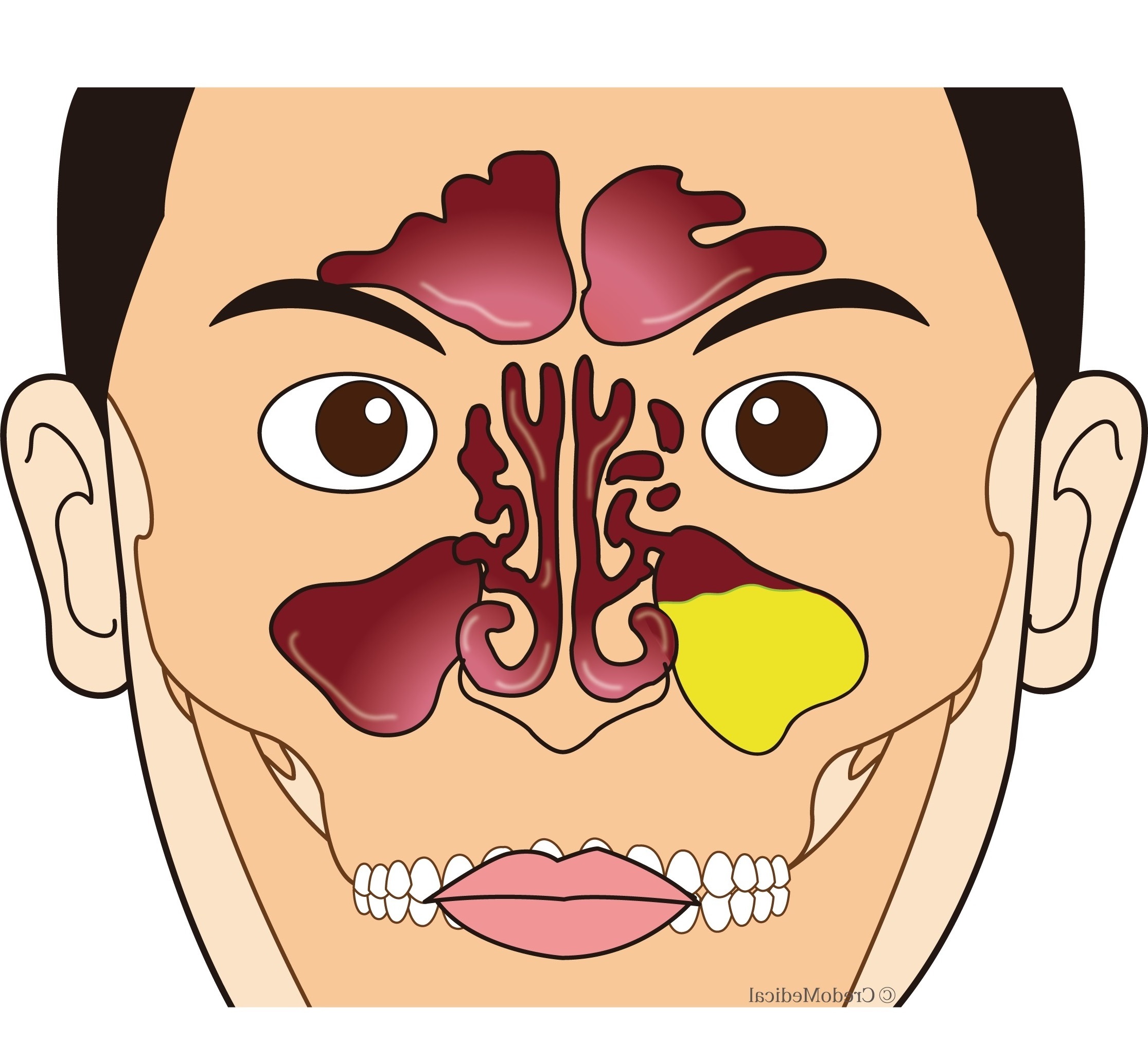 ロゴ入り図解副鼻腔の構造別パターン