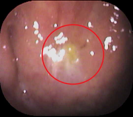 上咽頭1 - コピー