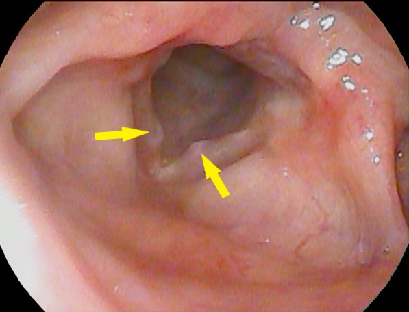 小児声帯結節-1