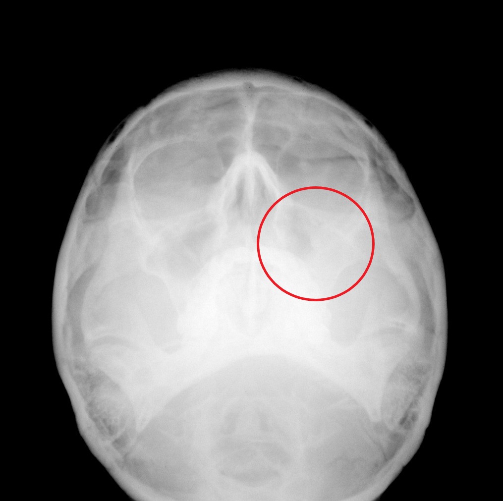 左上顎洞炎 - コピー