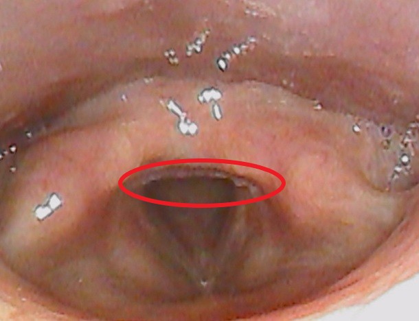 披裂間粘膜肥厚