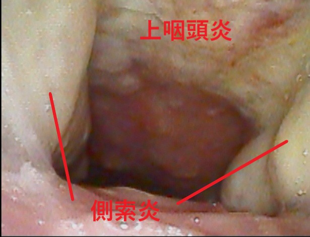 上咽頭炎