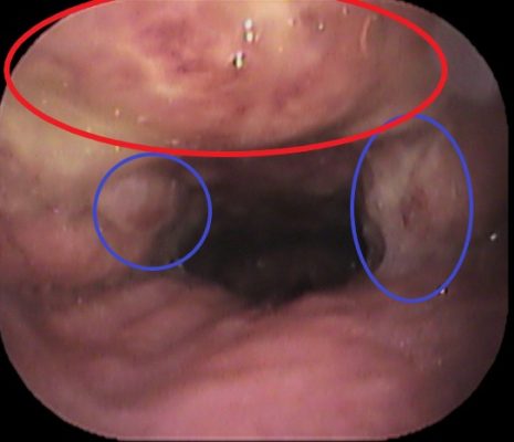 側索炎 - コピー